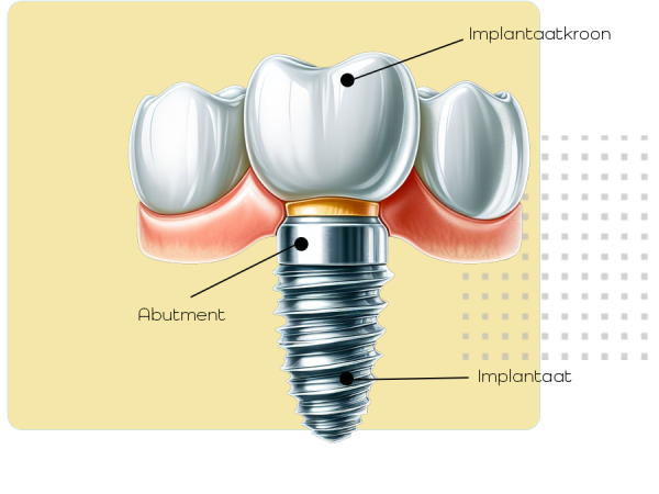 abutment