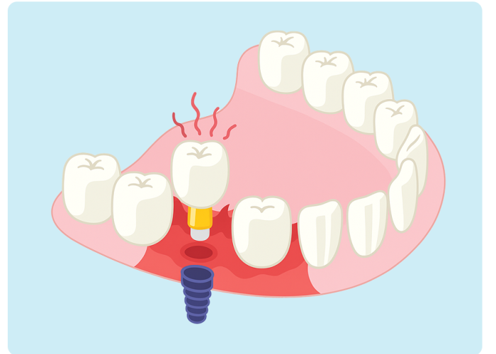 peri-implantitis